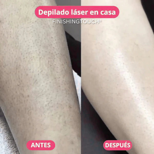 Depiladora Láser Corporal Glowé™
